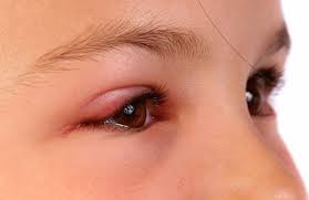 Mẹo điều trị mắt sưng đau hiệu quả với nguyên liệu đơn giản