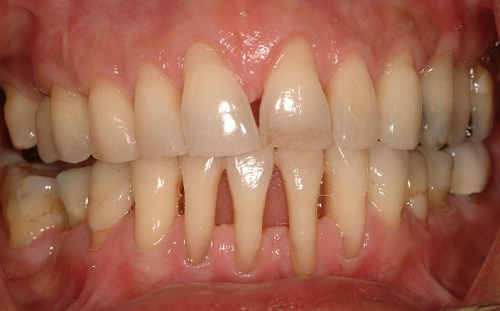 Viêm quanh răng - Nha chu viêm và hỗ trợ điều trị